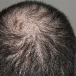 Hormonell bedingter Haarausfall