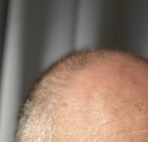 Hormonell bedingter Haarausfall