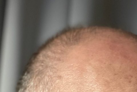 Hormonell bedingter Haarausfall