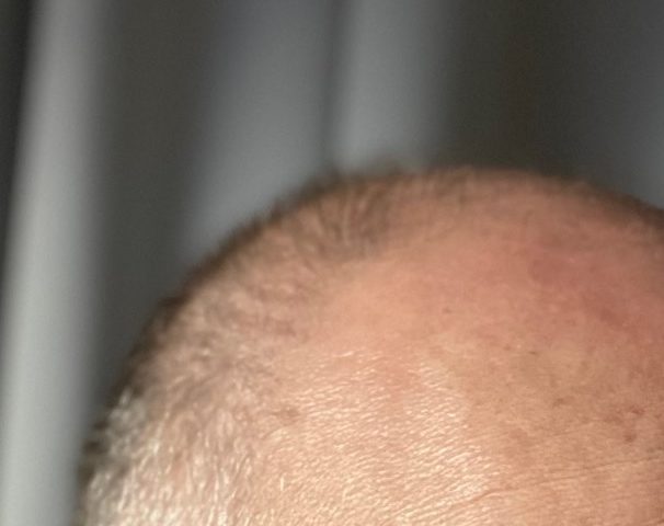 Hormonell bedingter Haarausfall