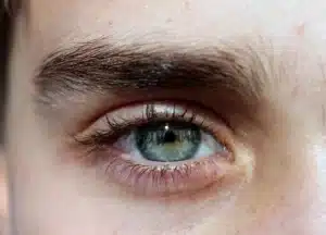 Augenbrauen Ausfall nach Chemotherapie